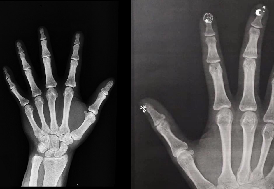 她手指夾傷照X光…網友一看結果大驚：是月光仙子！