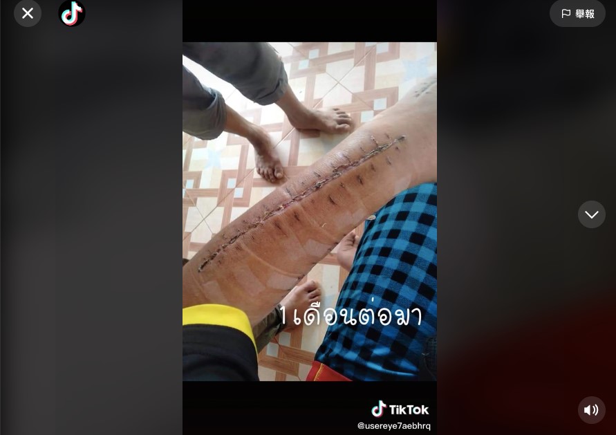 有片》泰國女子遭蛇咬傷手指 縫80針險遭截斷手臂