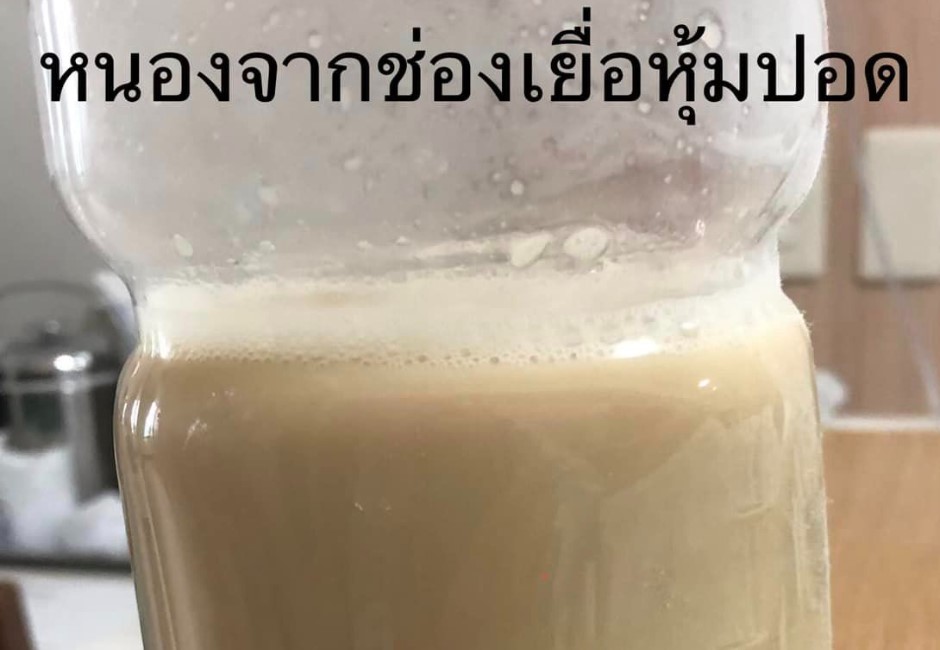 蛀牙害的！泰國男子胸疼發燒 就醫後抽出1.2公升惡臭濃液
