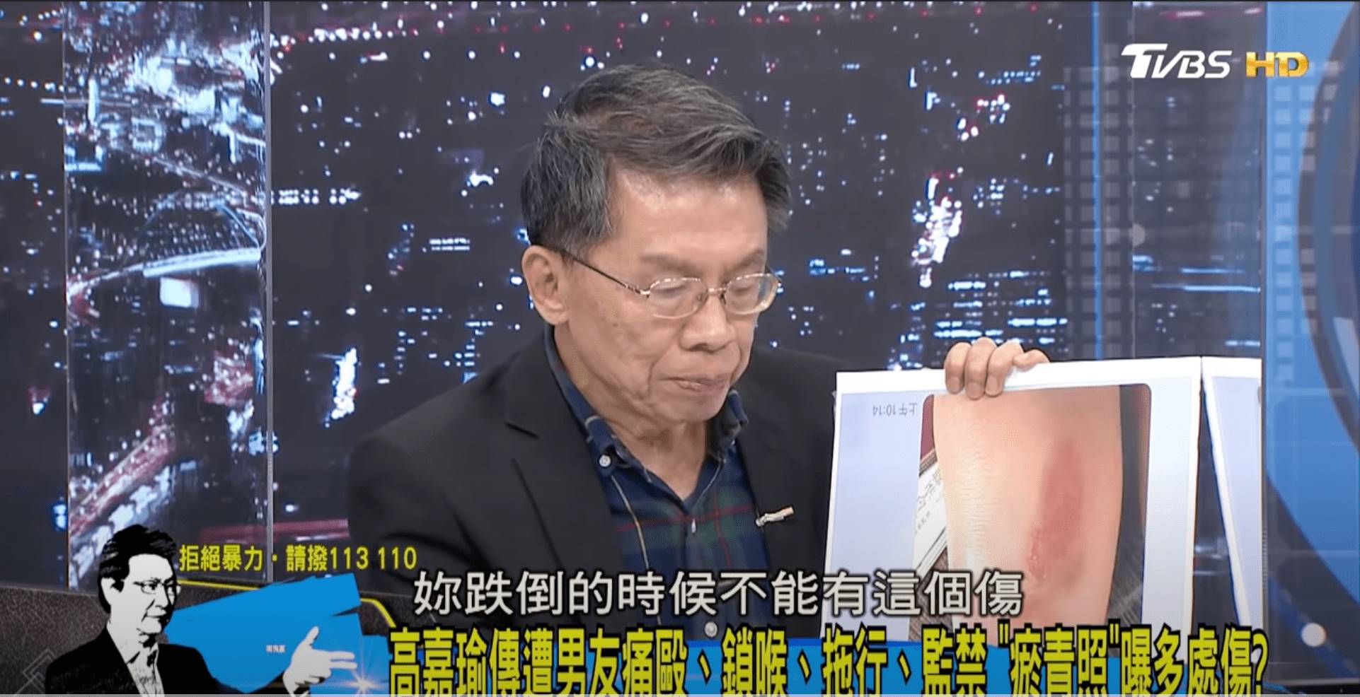 前立委沈富雄觀察高嘉瑜的傷勢照片，認為她稱跌傷並不可信。