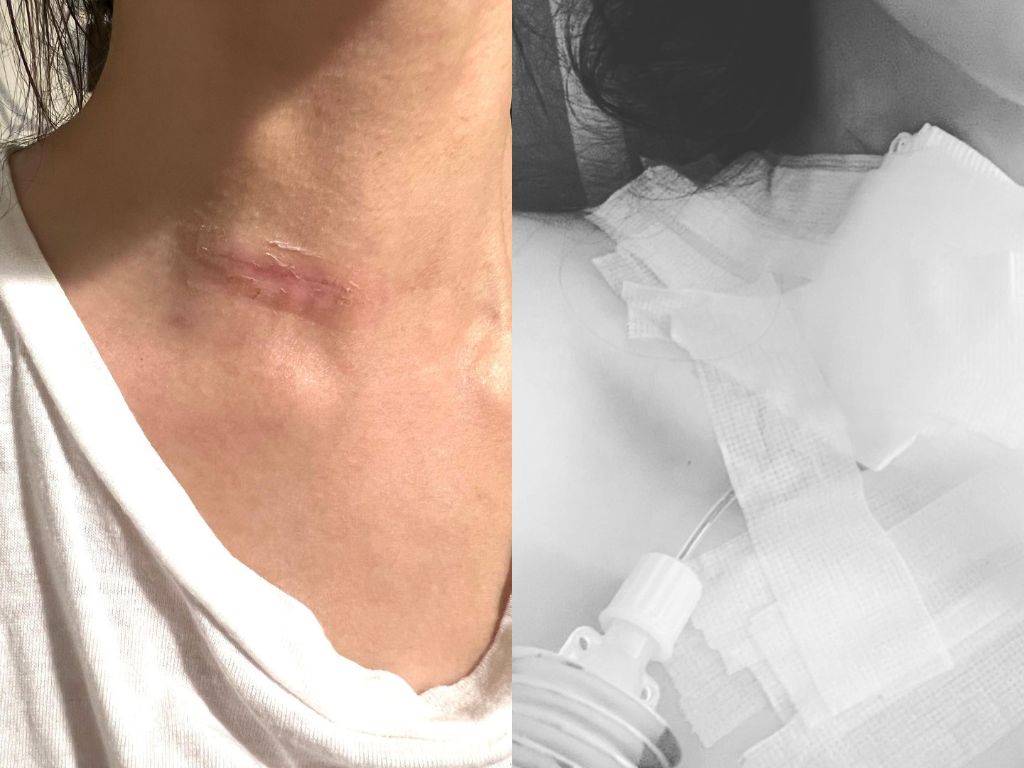 女星林欣霈罹患甲狀腺乳凸癌第一期