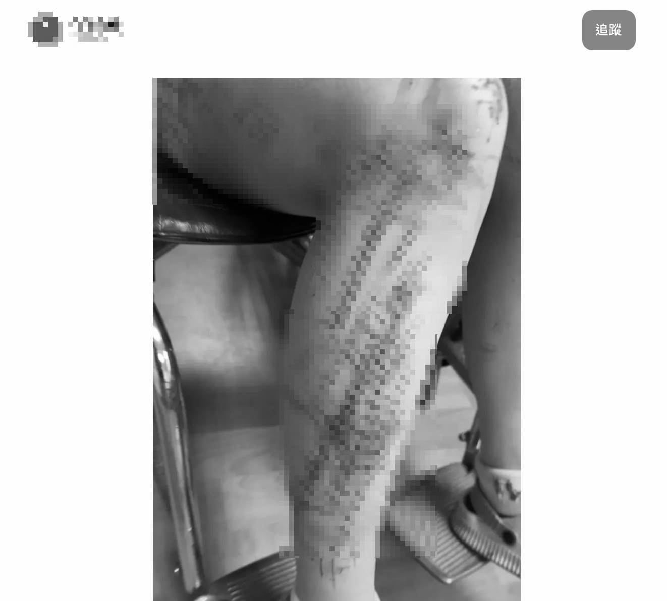 女網友在Dcard曝光飛行傘墜地後緊急送醫、自己坐在輪椅上傷痕累累的雙腿照。